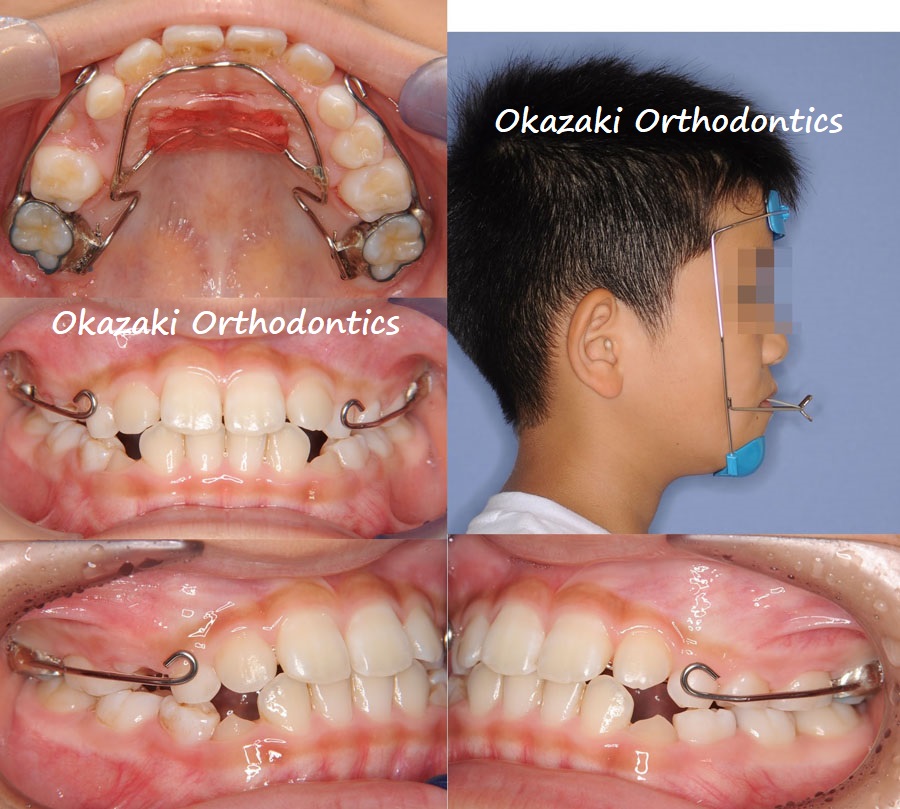 成長期の反対咬合治療例 | おかざき矯正歯科クリニック 茨城県水戸市の