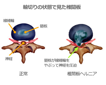 椎間板ヘルニア - はちや整形外科病院