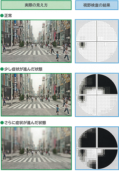 緑内障診療・手術｜大阪市住吉区 たかおか眼科クリニック｜メディカル
