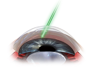 新しい緑内障治療（SLT）について｜福岡市 の 眼科 医療法人瑛和会