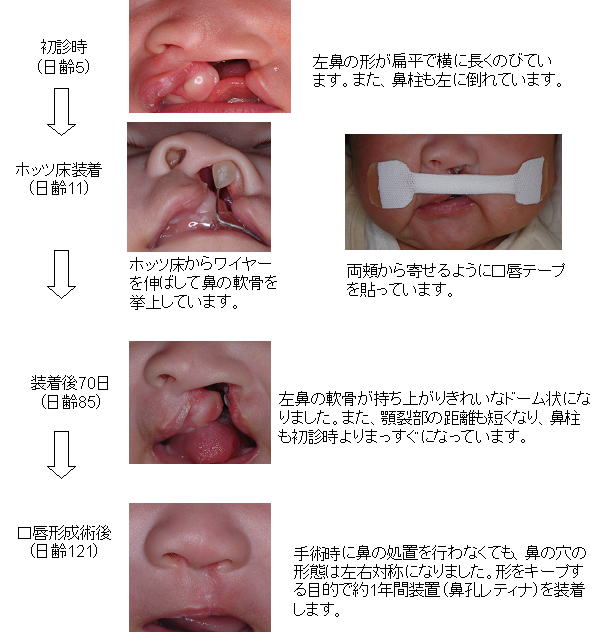 富山大学附属病院歯科口腔外科 口唇口蓋裂