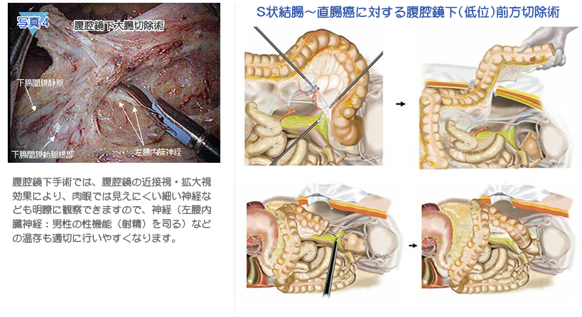 大腸疾患の外科治療について｜大腸がんの治療がわかる名医のWebサイト