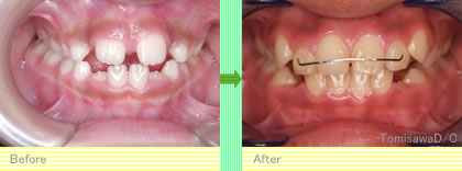 矯正治療の開始時期2＜調布市ー矯正歯科ーとみさわ歯科医院＞