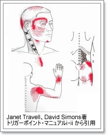 筋膜性疼痛症候群(MPS)・トリガーポイント - 江原鍼灸整骨院.