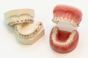 レベルアンカレッジシステム|【田隅矯正歯科クリニック】姫路駅直結の