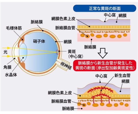 加齢⻩斑変性症 | 豊田四郷とみやす眼科 - 豊田市の眼科・小児眼科