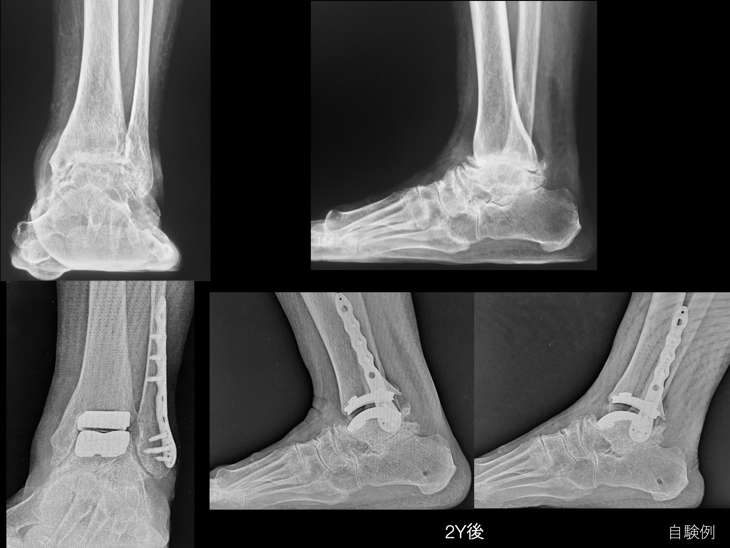 人工足関節置換手術 - 東京女子医科大学 膠原病リウマチ痛風センター
