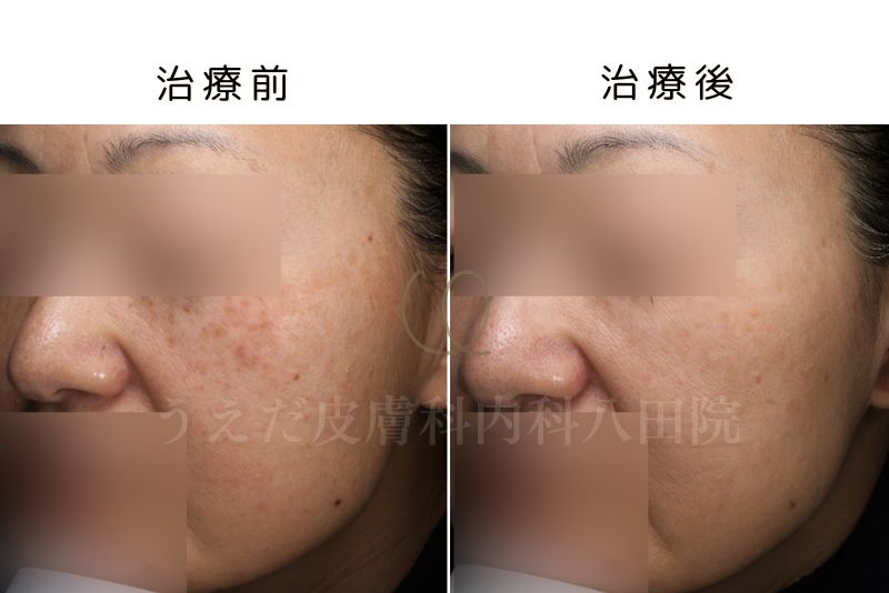 しみ・くすみ・そばかす・肝斑 | うえだ皮膚科内科 八田院 | 名古屋市