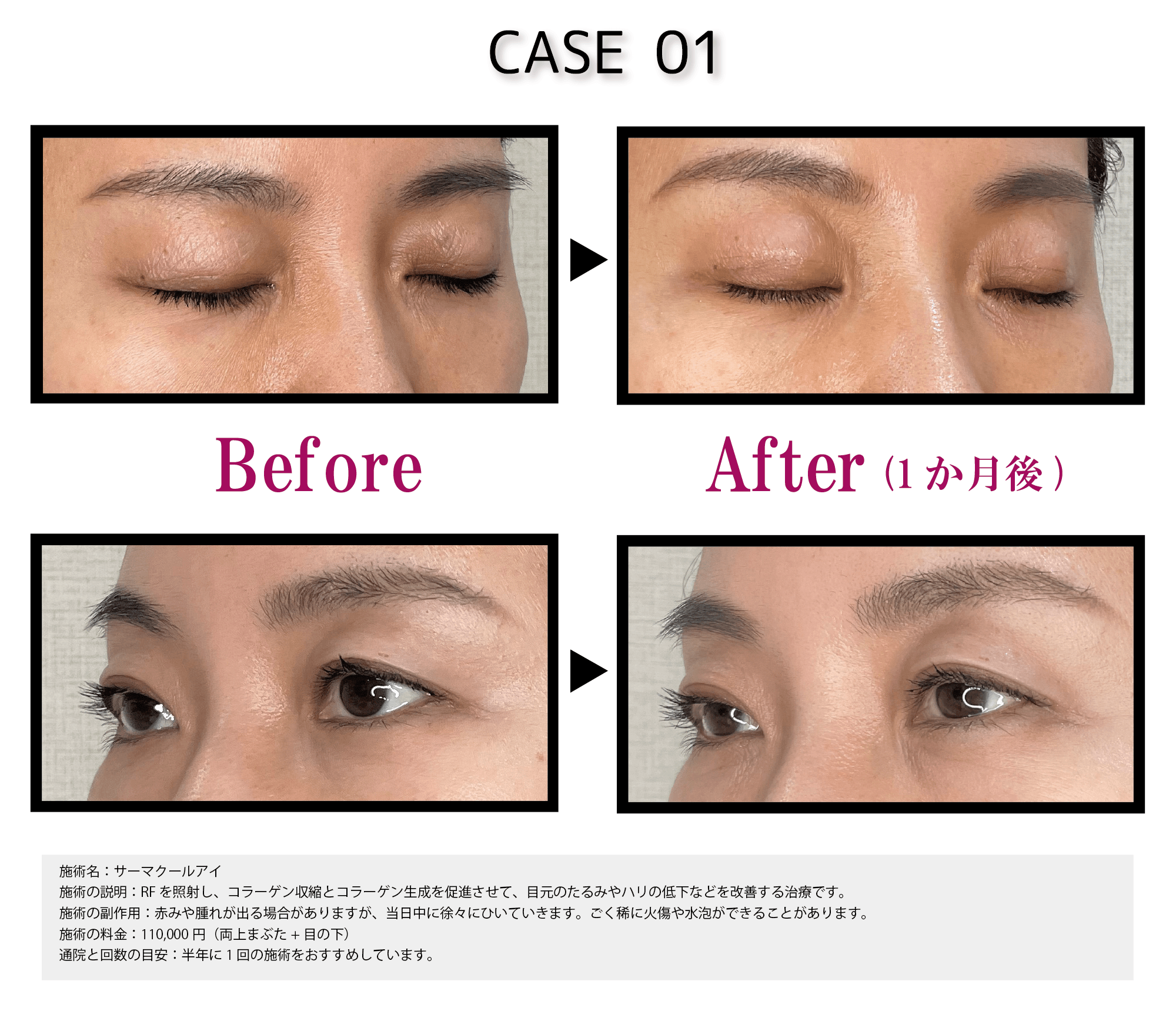 医師が解説】サーマクールアイとは？ビフォーアフター・効果・メリット