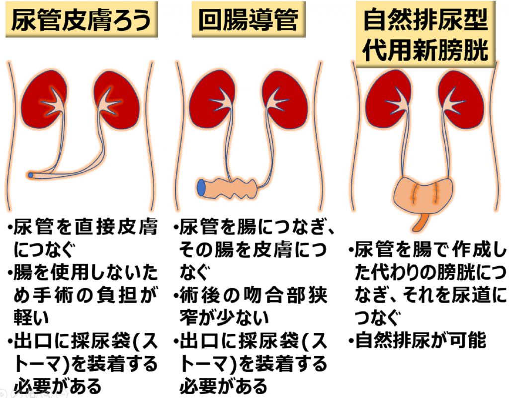 膀胱がん ロボット支援下膀胱全摘除術 ｜ロボット支援手術｜香川県立