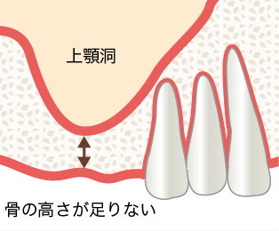 上顎洞底挙上術 | 笹塚あんず歯科