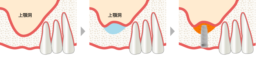 上顎洞底挙上術 | 笹塚あんず歯科