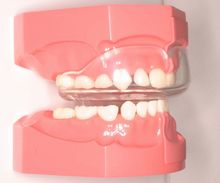 ムーシールド（乳歯列の受け口に使用する歯列矯正用咬合誘導装置