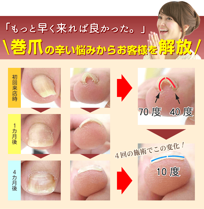 巻爪ケア講座｜あかり整足所