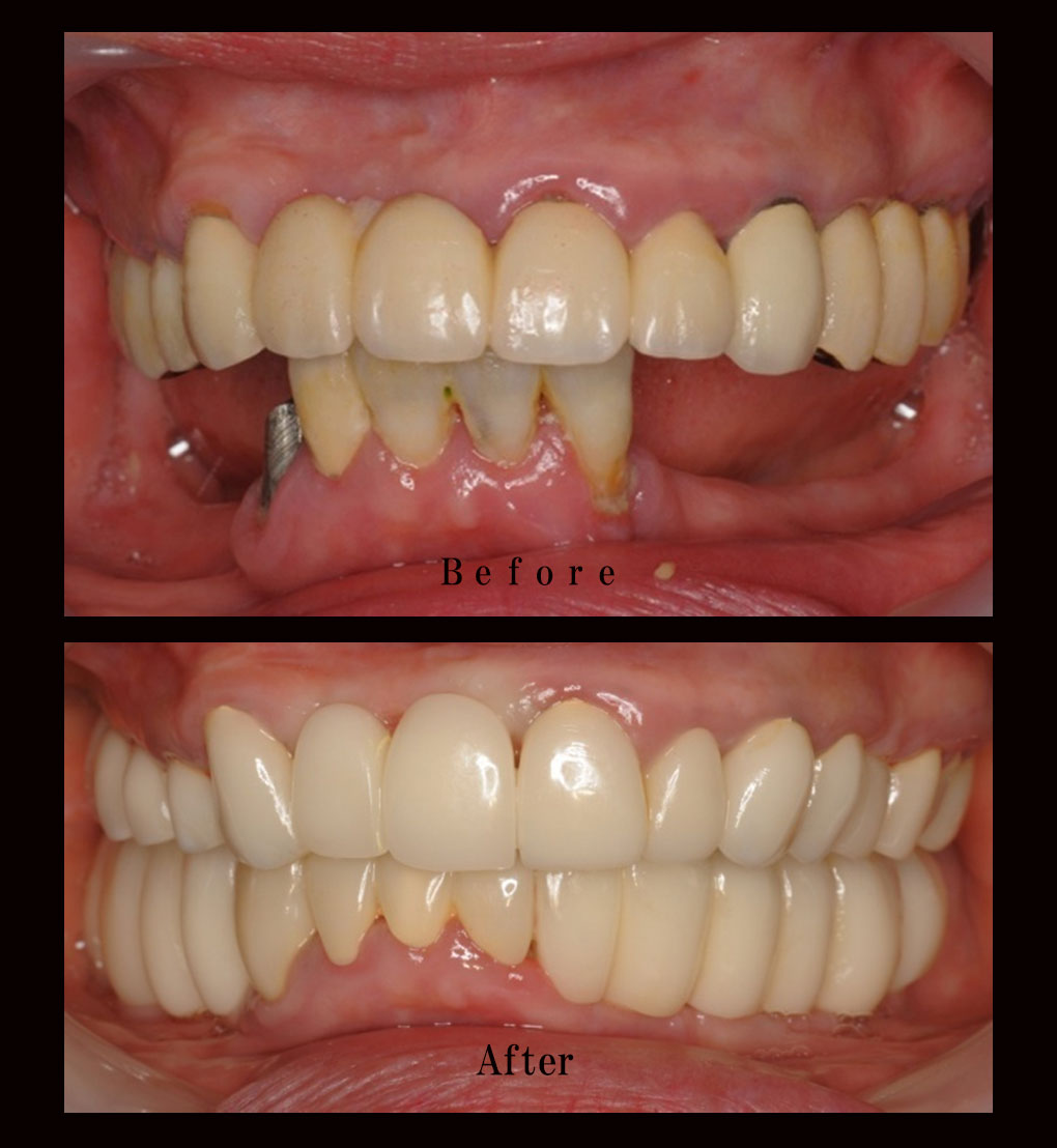 多数歯欠損ケース治療実績｜実績・症例｜朝霧 インプラント｜医療法人