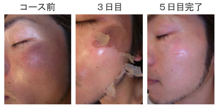 ハーブピーリングの王道「ハーバルピール」の専門店 EXSIALEが、期間