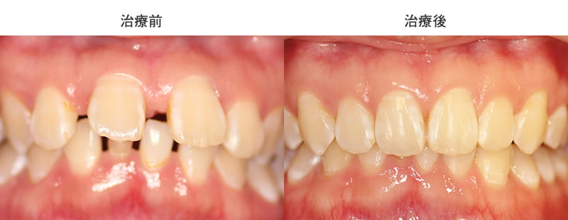非抜歯 | 部分矯正の診察室
