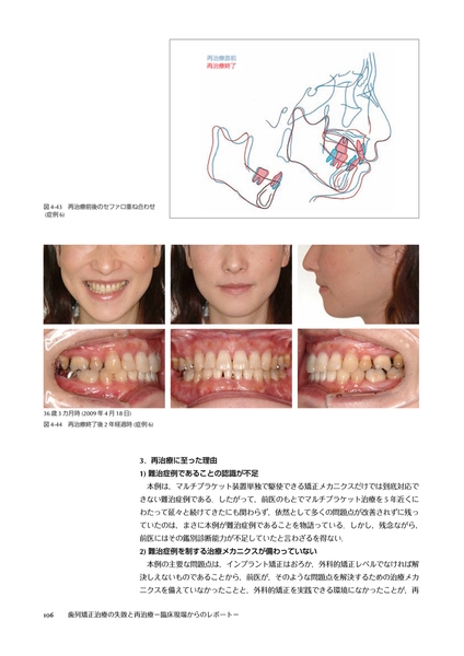 歯列矯正治療の失敗と再治療