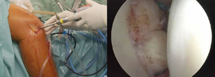 関節鏡・関節鏡視下手術とは：整形外科の専門手術 人工関節手術・関節