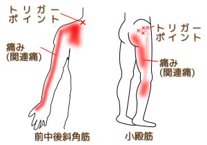 トリガーポイント療法 | トリガーポイント療法専門 もりかわ鍼灸治療院