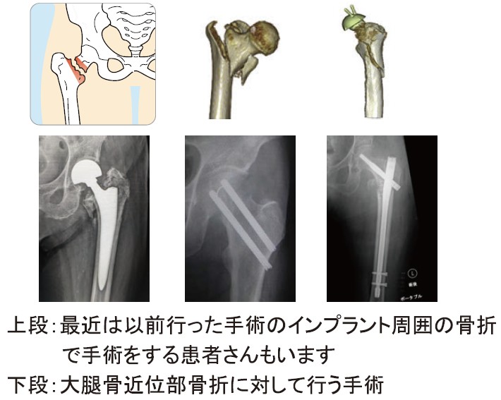 突然の股関節 大腿骨近位部骨折治療と2次骨折予防｜病気のはなし｜公立