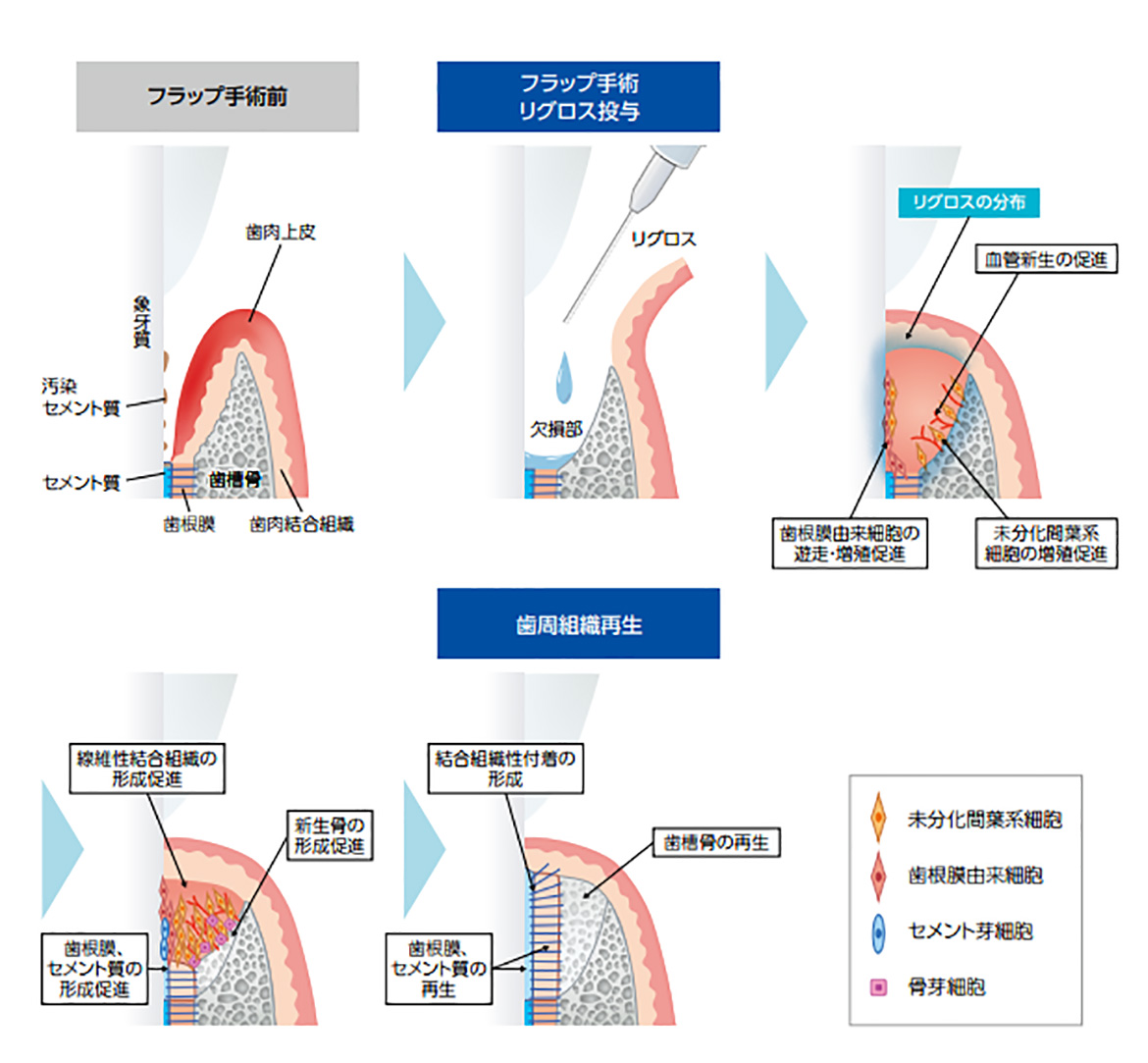 歯周組織再生療法（リグロス） : 東戸塚・横浜のインプラント、歯医者