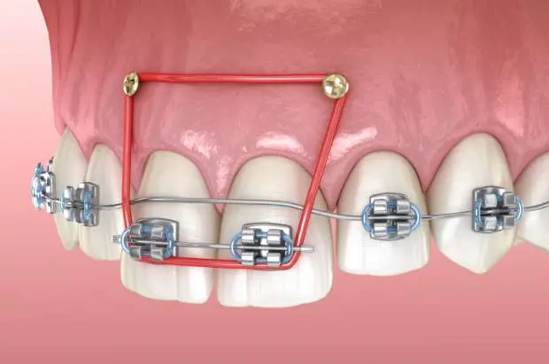 その他の矯正治療｜尼崎の矯正歯科、花田矯正歯科