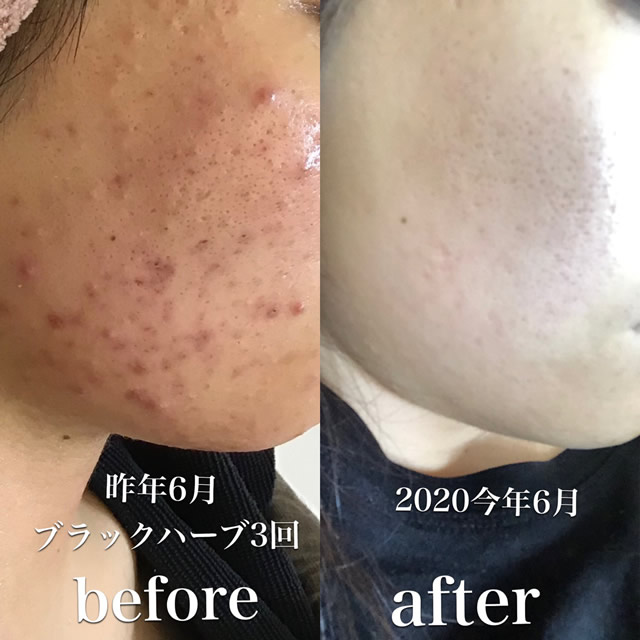 HERMOSA｜PURSUE エルモサハーブトリートメント