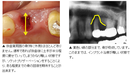 ソケットプリザベーション - 抜歯即時埋入ができない場合