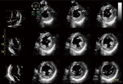 次世代のリアルタイム3D心エコー装置の開発－技術解説 - GEヘルスケア