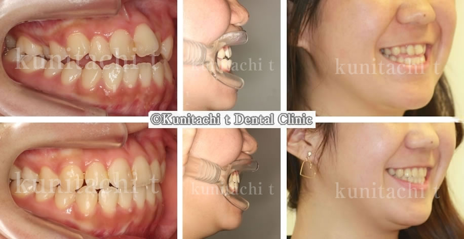 反対咬合＆開咬の矯正治療例（高校生 治療期間1年4ヶ月） | 国立t歯科