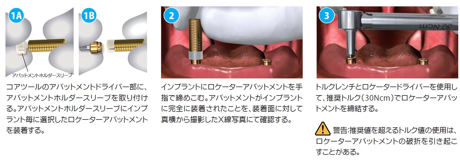 ロケーターアタッチメントシステム|株式会社インプラテックス