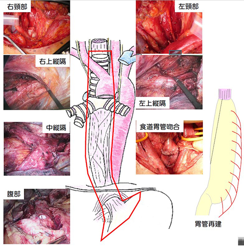 食道がん｜がんに関する情報｜がん研有明病院