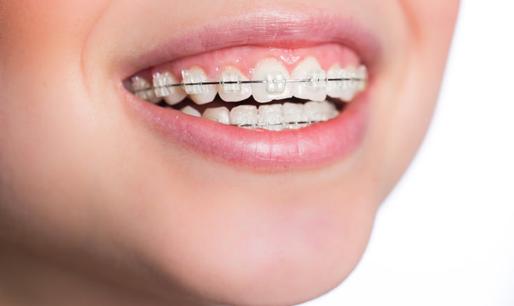 矯正歯科｜日暮里の歯医者｜日暮里じんデンタルクリニック・小児歯科