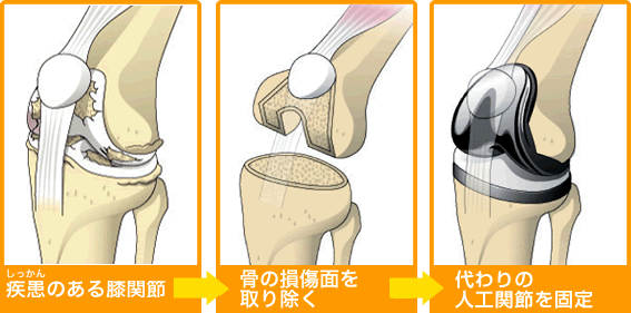人工ひざ関節置換術とは｜人工ひざ関節について｜人工関節ドットコム