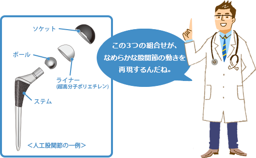 人工股関節置換術とは｜人工股関節について｜人工関節とは｜人工関節