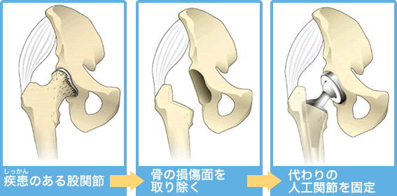 人工股関節置換術とは｜人工股関節について｜人工関節とは｜人工関節