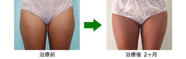 クールテック脂肪吸引 京都・滋賀の大西皮フ科形成外科医院