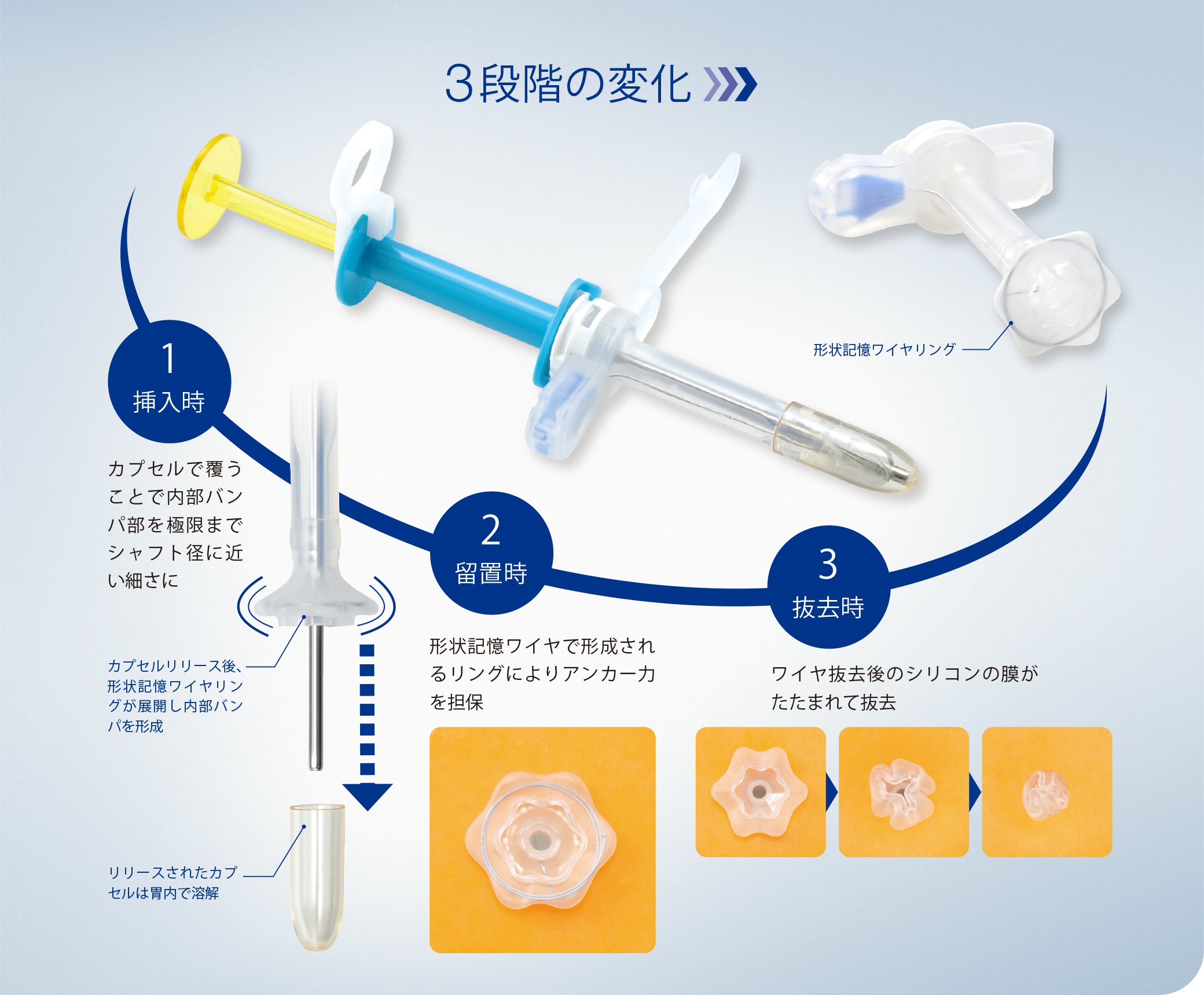 イディアルボタンZERO 交換用胃瘻カテーテル 胃留置型・バンパー型