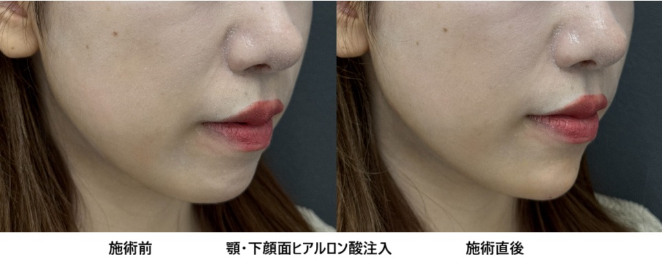 ヒアルロン注射による顎・下顔面形成治療20代女性⑦