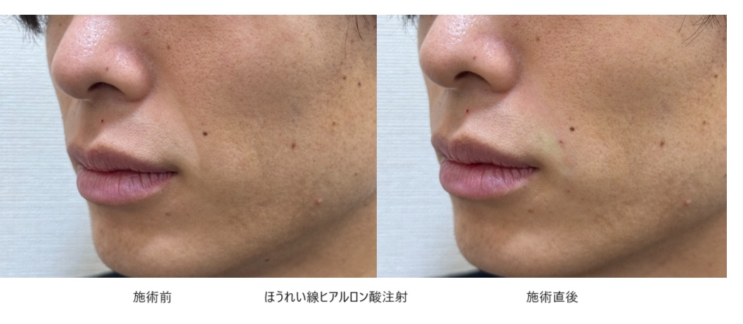 20代で既にほうれい線が目立っている人の原因と対策方法