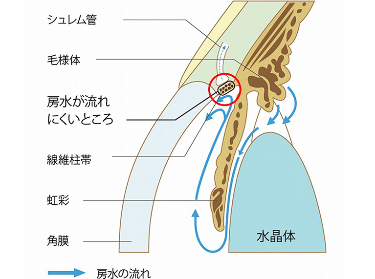 原発開放隅角緑内障とは｜眼科専門医の説明 | たおもと大浦アイクリニック
