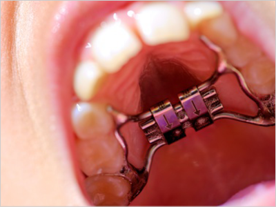 顎顔面矯正 - 豊中市岡町で歯列矯正治療なら、まつもと歯科