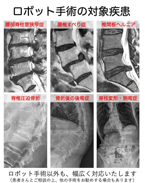Mazor Xによる脊椎のロボット手術 〜最新鋭の手術機器導入〜