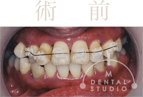 重度】30代女性「歯がボロボロ」インプラント10本以上必要と診断された