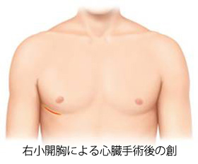 低侵襲心臓手術 :::大分大学医学部附属病院:心臓血管外科