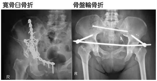外傷グループ - 患者様へ | 名古屋市立大学整形外科 - Department of