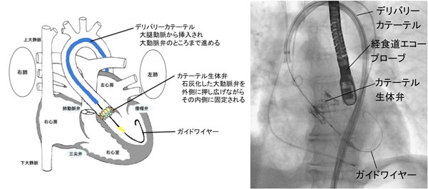弁膜症疾患｜心臓外科｜心臓血管外科部門｜診療科・部門のご案内｜国立