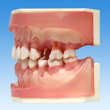 歯周病学基礎実習用顎模型(歯槽歯肉クリアピンク色・D咬合器つき