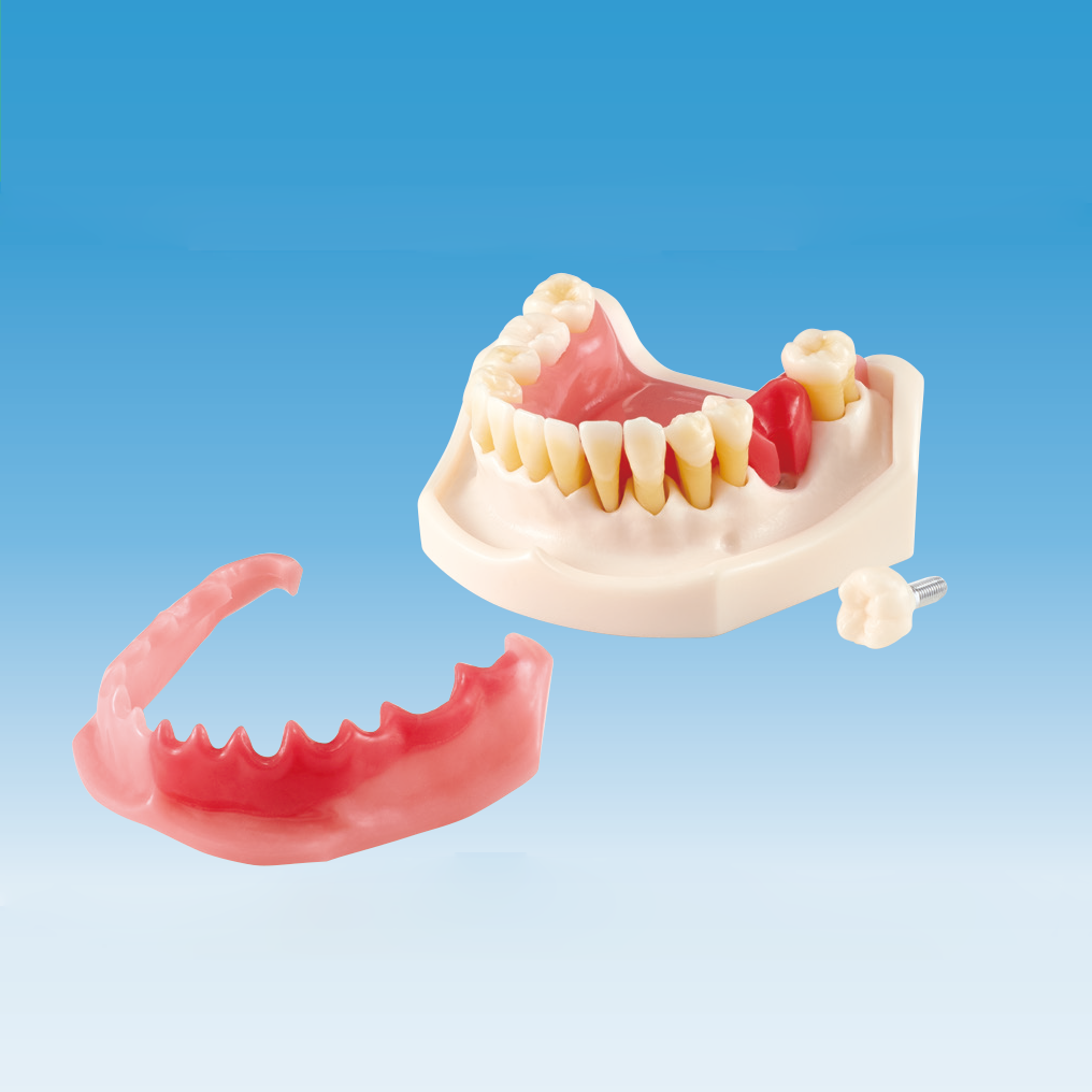 歯周病・インプラント周囲炎説明用模型 [PE-PER015]｜株式会社ニッシン